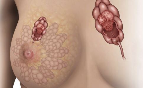這些癥狀是乳腺癌前兆 5招預(yù)防乳癌