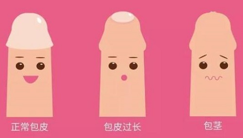 男性割包皮怎么樣 盤點割包皮的好處與壞處