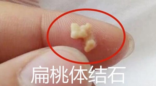 一招讓扁桃體結(jié)石自己排出來怎么做 扁桃體結(jié)石脫落小妙招有哪些