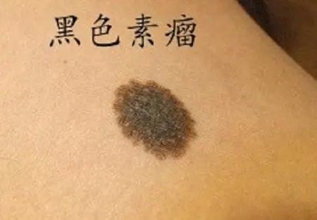 黑色素瘤和普通痣的區別是什么 怎么判斷是不是黑色素瘤