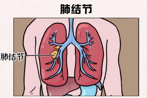 肺部結(jié)節(jié)要吃藥嗎 肺部有結(jié)節(jié)可以治愈嗎