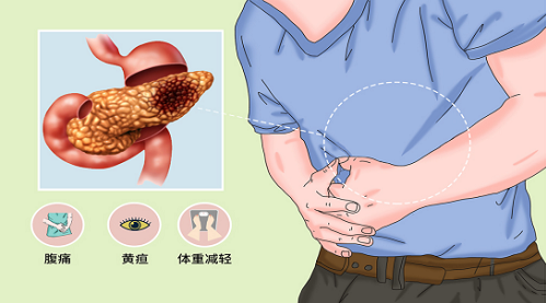 胰腺癌的早期癥狀是什么 哪7種人最易得胰腺癌