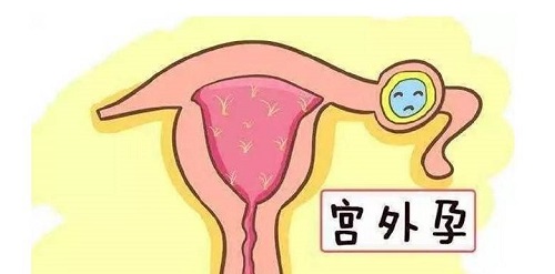 哪8個征兆說明你宮外孕了 宮外孕一般多久有感覺