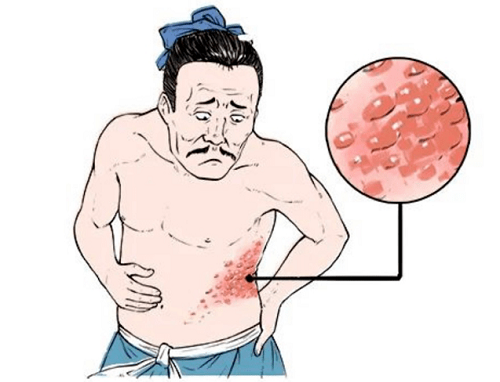 皰疹不能吃六種東西是什么 得了皰疹能吃雞蛋嗎