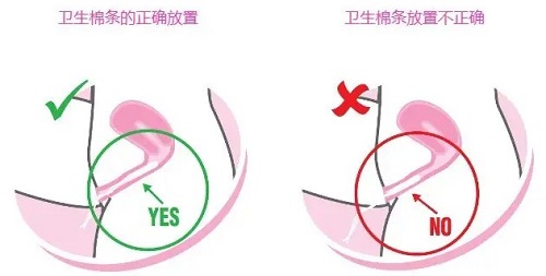 衛生棉條怎么用步驟 女生使用衛生棉條需要注意什么