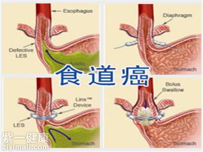 食道癌早期癥狀是什么 食道癌和咽炎最大區(qū)別是什么
