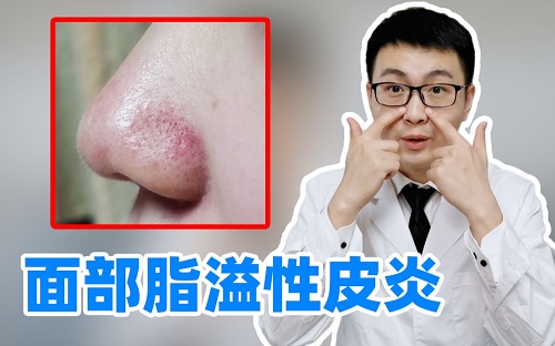 面部脂溢性皮炎癥狀是什么 面部脂溢性皮炎癥如何治療