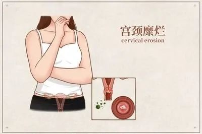 宮頸糜爛的危害是什么 宮頸糜爛怎么治療好