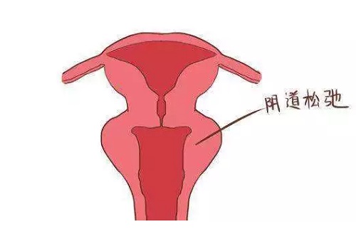 女生陰道松弛怎么解決好 什么方法對陰道松弛有效果