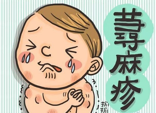 蕁麻疹的治療偏方有哪些 蕁麻疹怎么治療最好