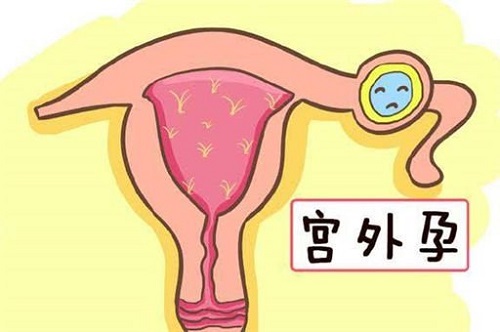 宮外孕癥狀早期是什么 宮外孕癥狀多久能發現