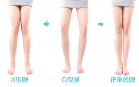 女生雙腿合不攏是怎么回事 女生腿型不美怎么改善