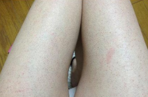 毛囊角質化怎么辦 毛囊角質化是怎么引起的
