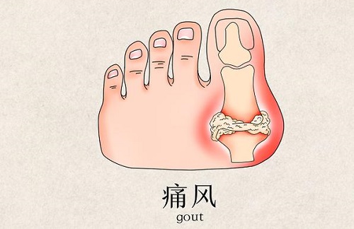 痛風能吃什么食物一覽表 女人痛風先痛在哪里