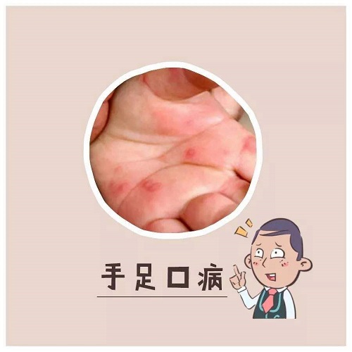 手足口病吃什么藥 手足口病可以洗澡碰水嗎