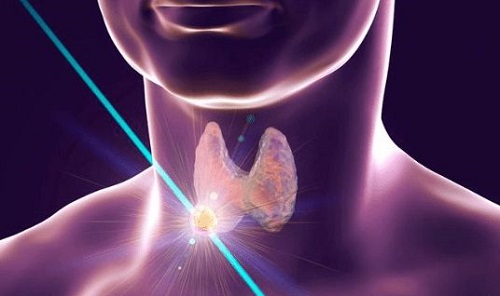 甲狀腺結節能喝茶嗎 甲狀腺結節能喝咖啡嗎