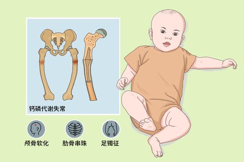 佝僂病的早期癥狀是什么 佝僂病是很嚴重的病嗎
