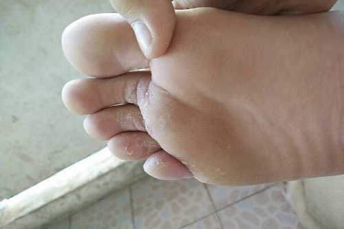 腳脫皮是什么原因造成的 腳脫皮還癢怎么治療