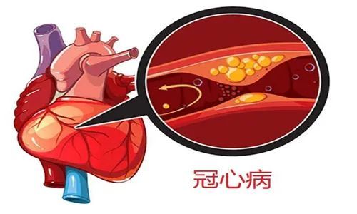 冠心病飲食禁忌有哪些 冠心病是怎樣形成的