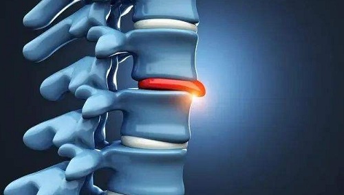 腰椎突出嚴重怎么辦 腰椎突出可以過性生活嗎