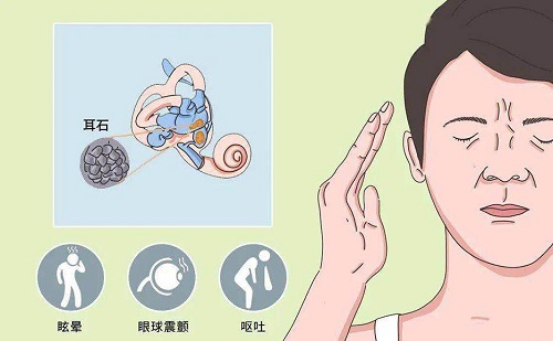 耳石癥快速自愈方法有哪些 耳石癥是怎么造成的