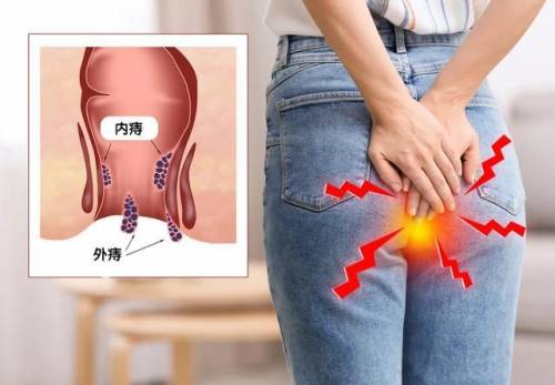 怎么區(qū)分痔瘡出血和腸道出血 如何判斷自己長了痔瘡