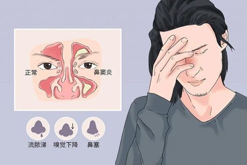 鼻竇炎吃什么藥 怎樣判斷是不是鼻竇炎