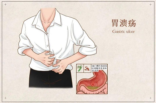 胃潰瘍吃什么食物好 怎么判斷自己是胃潰瘍