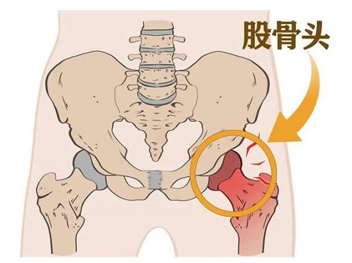 股骨頭壞死早期癥狀是什么 股骨頭壞死的并發(fā)癥有哪些