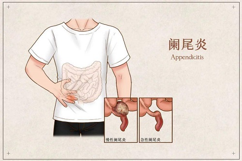 闌尾炎吃什么好 闌尾炎忌口的水果有哪些