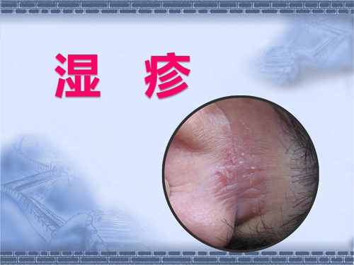 怎么才能治好濕疹 濕疹被分為哪些類型