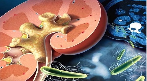 腎結石是怎么產生的 腎結石一般那個位置疼