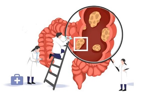 腸癌最明顯的一個(gè)征兆是什么 腸癌是怎樣造成的