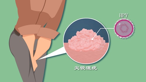 尖銳正常人多久能治愈 男性濕銳尖會自愈嗎
