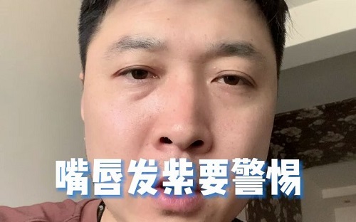 嘴唇發紫是什么原因 嘴唇發紫是身體哪里不好