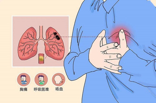 肺栓塞的主要癥狀是什么 肺栓塞是什么原因引起的