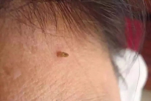 脖子上長了很多小疣怎么辦 為什么頸部會突然長疣