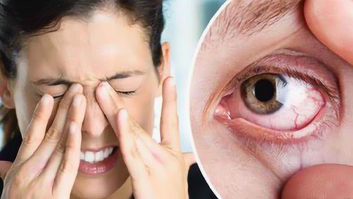 眼睛干澀是什么原因引起的 眼睛干澀用什么藥效果好