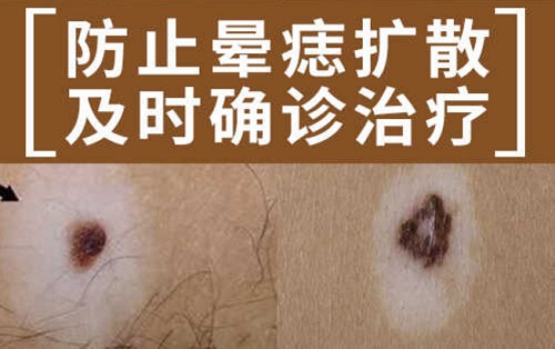 暈痣不治療會怎樣 暈痣怎么治療最有效