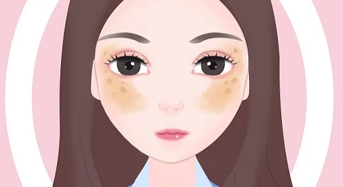 女人為什么會長黃褐斑 長了黃褐斑要注意哪些