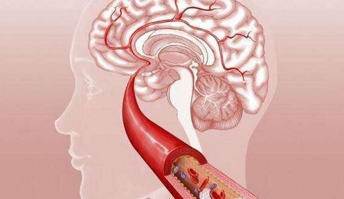 腦血栓要注意什么 腦血栓的形成原因是什么