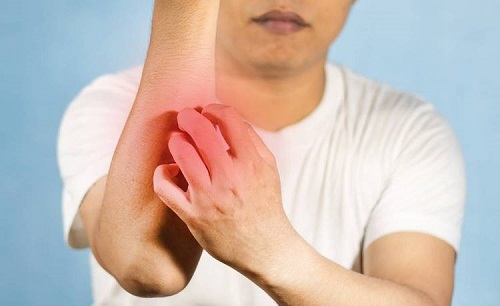 濕疹止癢妙招是什么 濕疹可以吃西瓜嗎