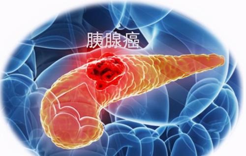 胰腺癌的早期癥狀是什么 胰腺癌怎么引起