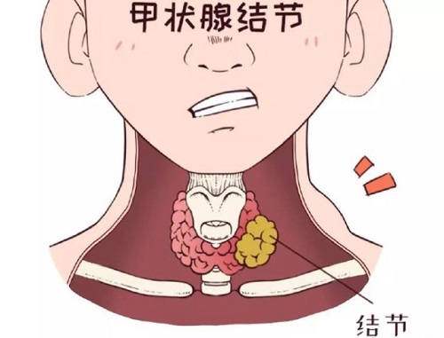 甲狀腺結節怎么治療最好 甲狀腺結節是怎么引起的