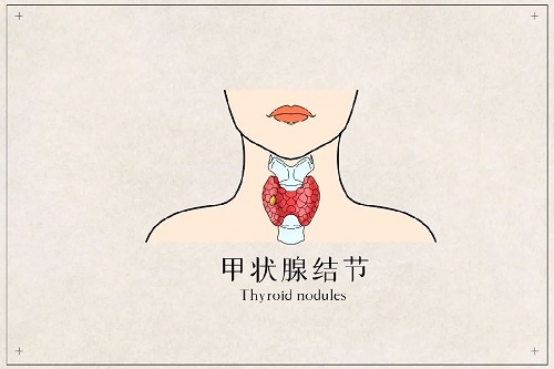甲狀腺結節怎么治療最好 甲狀腺必吃五種水果是什么