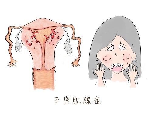 肌腺癥需要手術(shù)嗎 肌腺癥手術(shù)后多久能懷孕