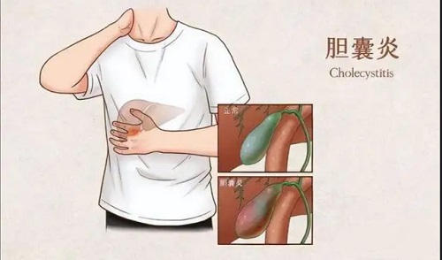 膽囊炎的癥狀是哪里疼 膽囊炎吃啥藥最好