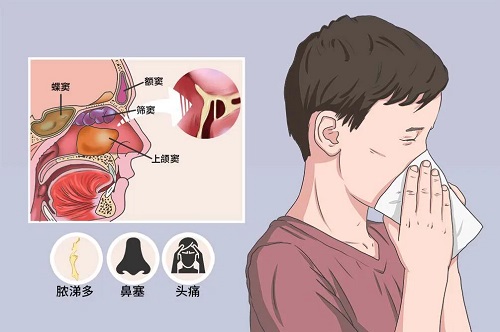 如何醫治鼻竇炎 鼻炎和鼻竇炎哪個嚴重