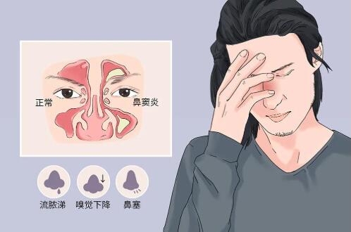 如何醫治鼻竇炎 鼻竇炎長期不治會怎樣