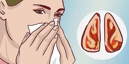 如何醫治鼻竇炎 鼻竇炎是怎么引起的